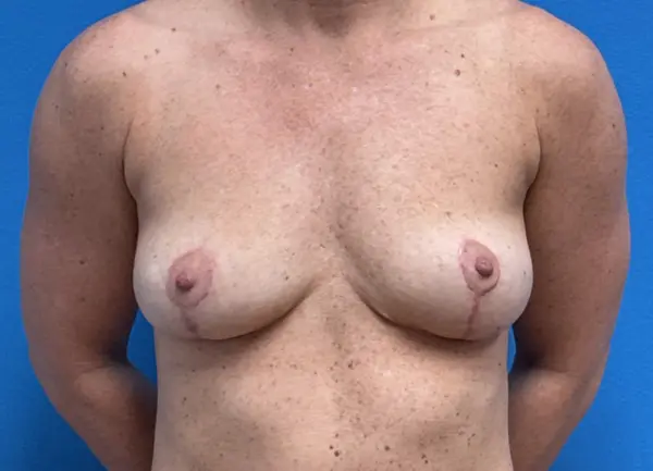 Implant Removal Case 21