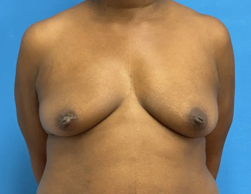 Breast Augmentation Before & After Pictures near Fort Lauderdale, FL