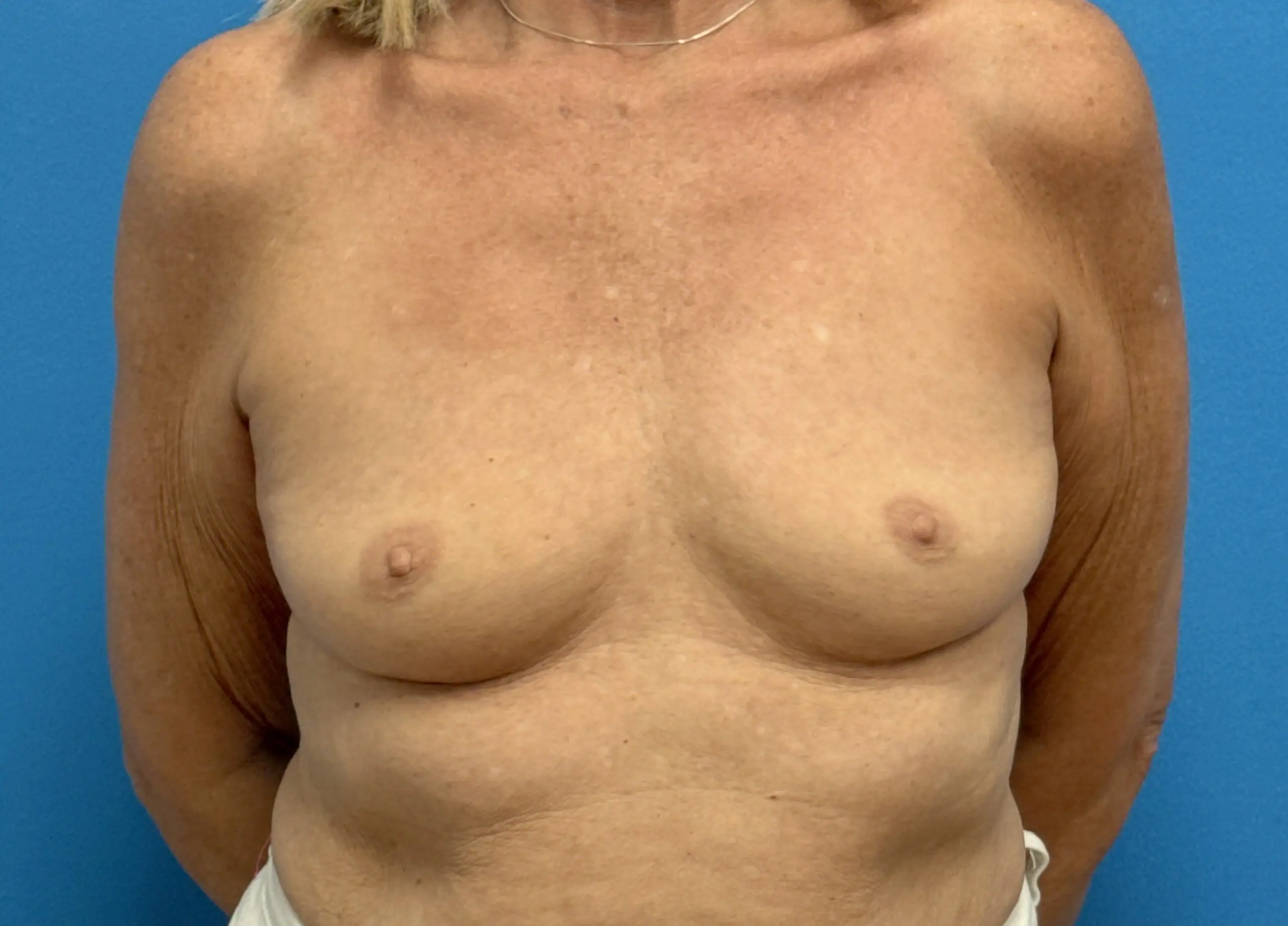 Breast Augmentation Before & After Pictures near Fort Lauderdale, FL