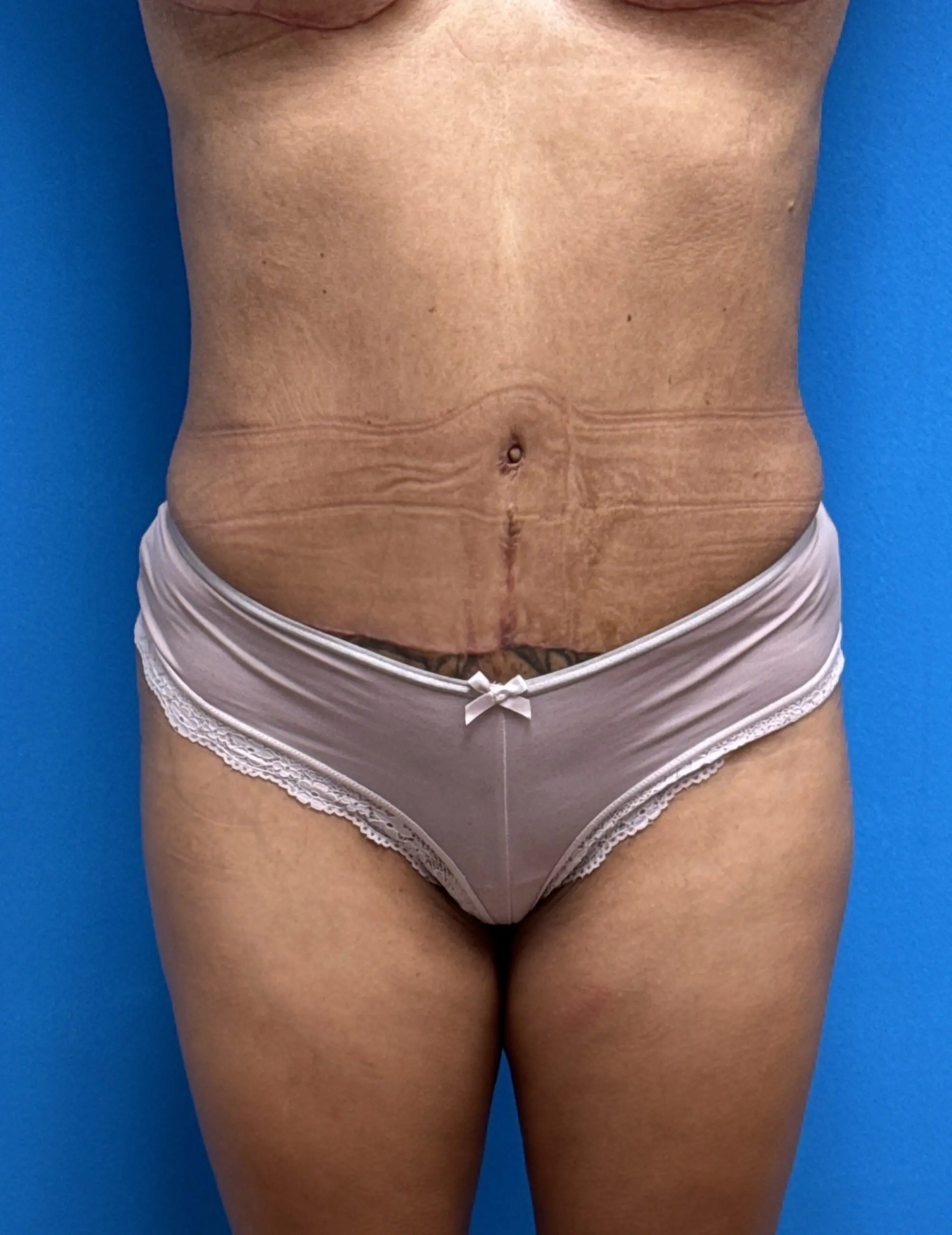 03142025 131000 (1) Tummy Tuck Before & After Pictures near Fort Lauderdale, FL