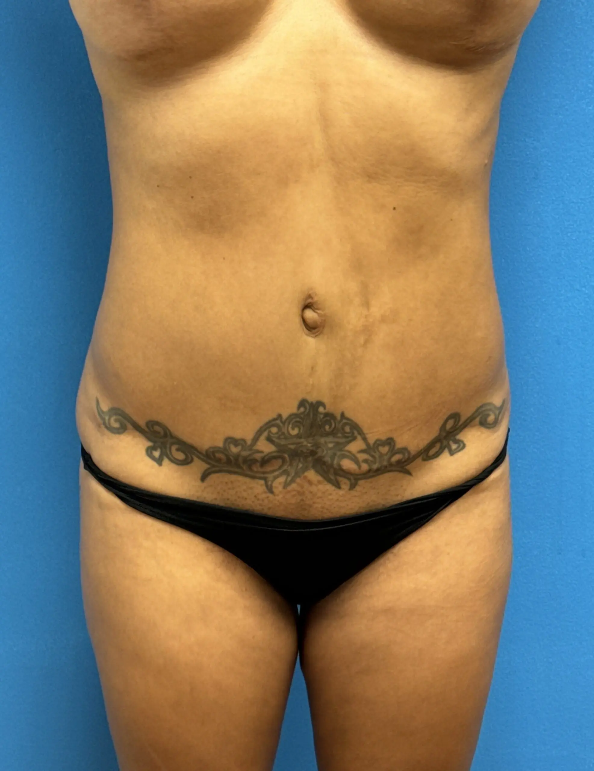 09112024 135600 Tummy Tuck Before & After Pictures near Fort Lauderdale, FL