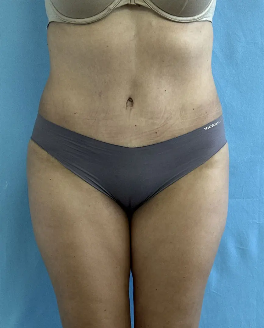 tummy-tuck-case-62-front-after Tummy Tuck Before & After Pictures near Fort Lauderdale, FL