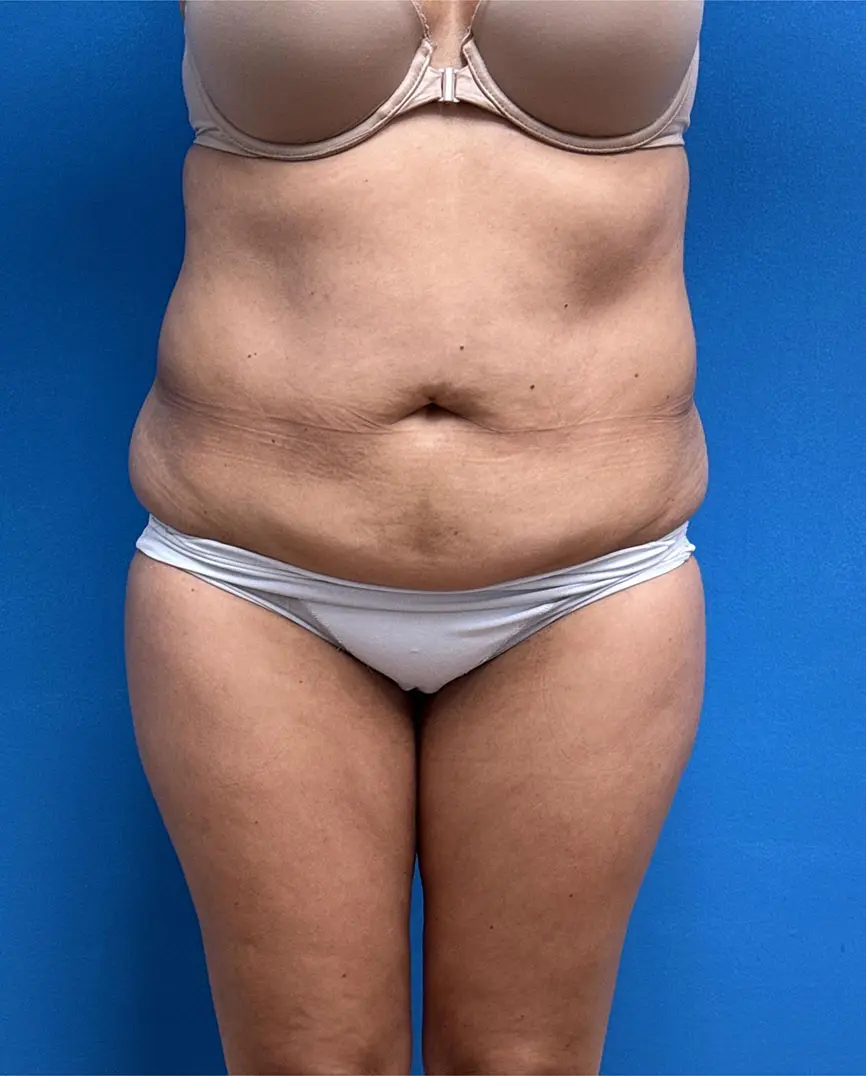tummy-tuck-case-62-front-before Tummy Tuck Before & After Pictures near Fort Lauderdale, FL