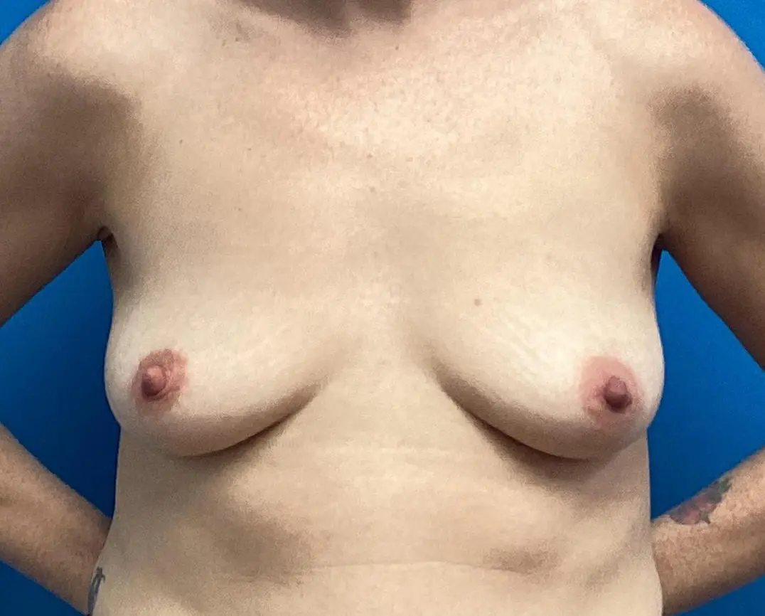 Breast Augmentation Before & After Pictures near Fort Lauderdale, FL