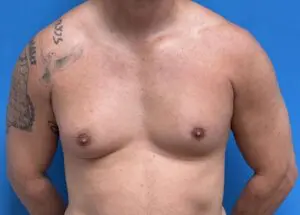 Gynecomastia Before and After Pictures Fort Lauderdale, FL