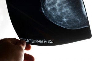 Breast Reconstruction After Mastectomy Safe for Women of All Ages