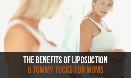 WHY MOMS LOVE LIPOSUCTION AND THE TUMMY TUCK IN CORAL SPRINGS