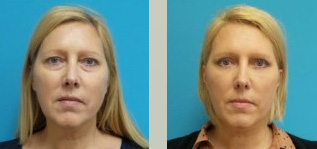 Blepharoplasty Before and After Pictures Fort Lauderdale, FL