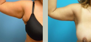Brachioplasty Before and After Pictures Fort Lauderdale, FL