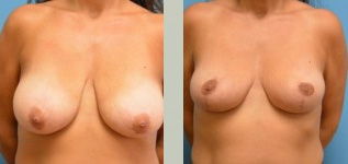 Breast Lift Before and After Pictures Fort Lauderdale, FL