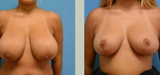 Breast Reduction Before and After Pictures Fort Lauderdale, FL