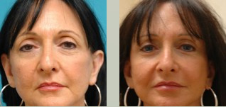 Brow Lift Before and After Pictures Fort Lauderdale, FL