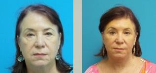 Facelift Before and After Pictures Fort Lauderdale, FL