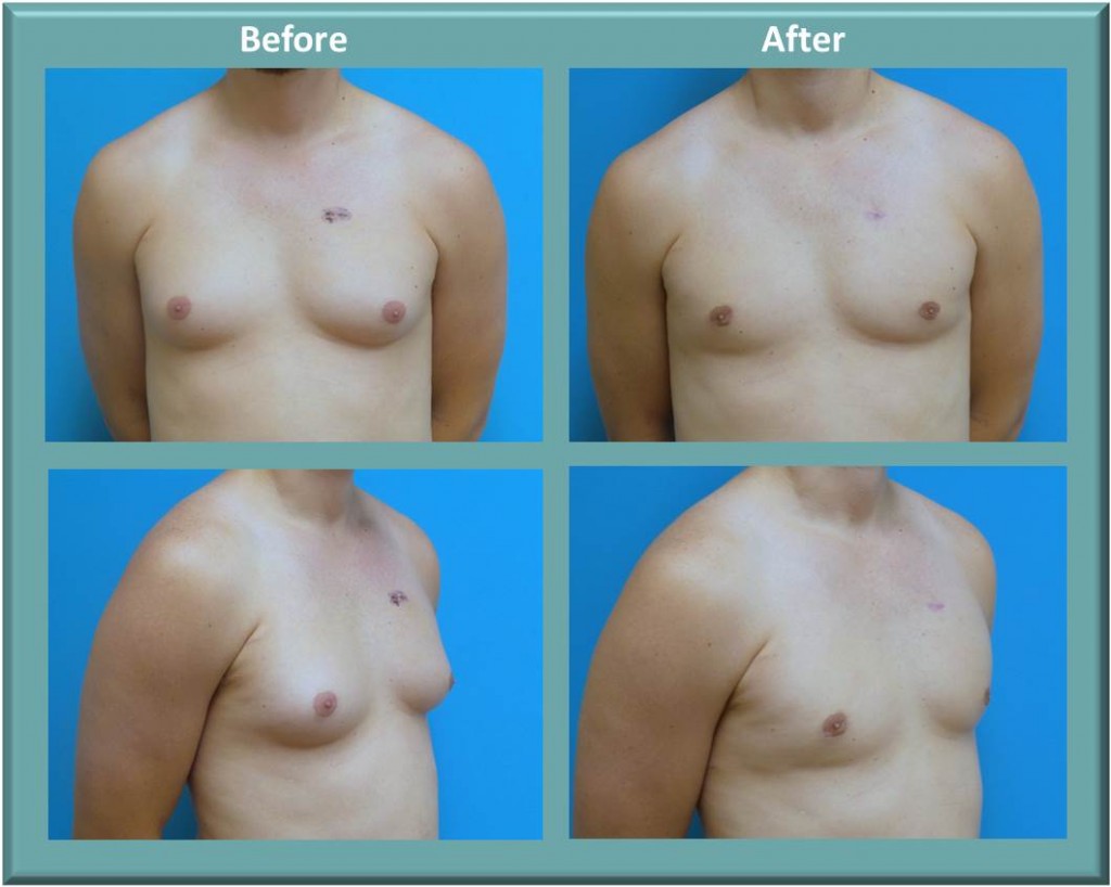 Gynecomastia Before and After Pictures Fort Lauderdale, FL