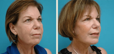 Chin Augmentation Before and After Pictures Fort Lauderdale, FL