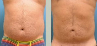 Male Liposuction Before and After Pictures Fort Lauderdale, FL