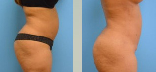 Liposuction Before and After Pictures Fort Lauderdale, FL