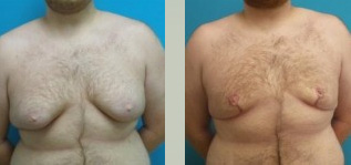 Gynecomastia Before and After Pictures Fort Lauderdale, FL