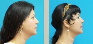 Neck Liposuction Before and After Pictures Fort Lauderdale, FL