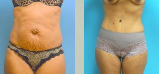 Tummy Tuck Before and After Pictures Fort Lauderdale, FL