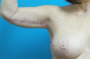 Brachioplasty Before and After Pictures Fort Lauderdale, FL