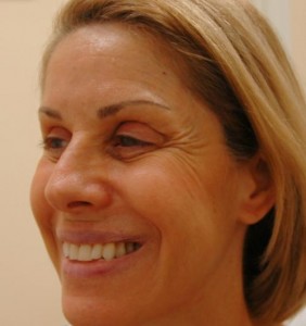 Botox/Dysport Before and After Pictures Fort Lauderdale, FL