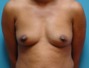 Breast Augmentation Before and After Pictures Fort Lauderdale, FL