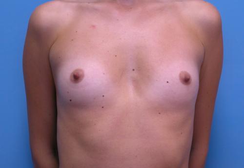 Breast Augmentation Before and After Pictures Fort Lauderdale, FL