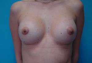 Breast Augmentation Before and After Pictures Fort Lauderdale, FL