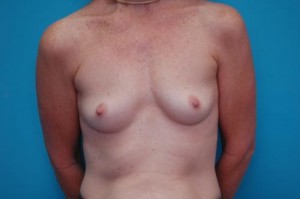 Breast Augmentation Before and After Pictures Fort Lauderdale, FL