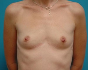 Breast Augmentation Before and After Pictures Fort Lauderdale, FL