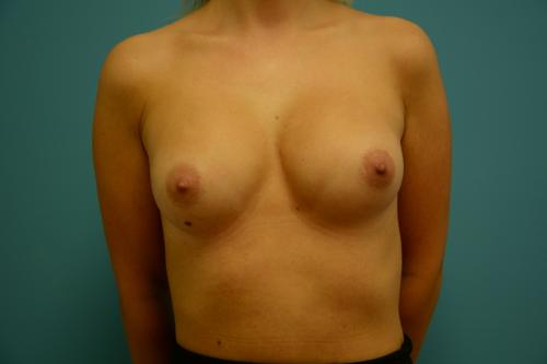 Breast Augmentation Before and After Pictures Fort Lauderdale, FL