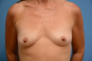 Breast Augmentation Before and After Pictures Fort Lauderdale, FL