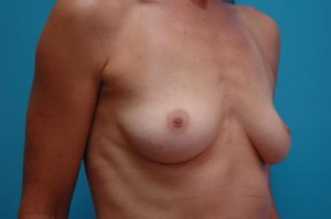 Breast Augmentation Before and After Pictures Fort Lauderdale, FL