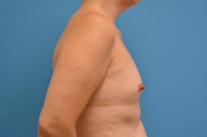 Breast Augmentation Before and After Pictures Fort Lauderdale, FL