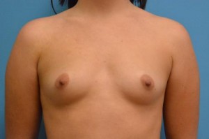 Breast Augmentation Before and After Pictures Fort Lauderdale, FL