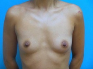 Breast Augmentation Before and After Pictures Fort Lauderdale, FL