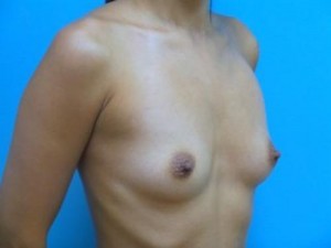 Breast Augmentation Before and After Pictures Fort Lauderdale, FL