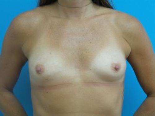 Breast Augmentation Before and After Pictures Fort Lauderdale, FL