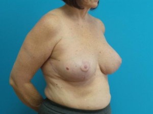 Breast Implant Revision/Replacement Before and After Pictures Fort Lauderdale, FL