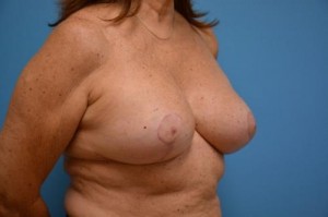 Breast Implant Revision/Replacement Before and After Pictures Fort Lauderdale, FL