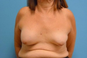 Breast Implant Revision/Replacement Before and After Pictures Fort Lauderdale, FL