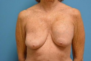 Breast Implant Revision/Replacement Before and After Pictures Fort Lauderdale, FL