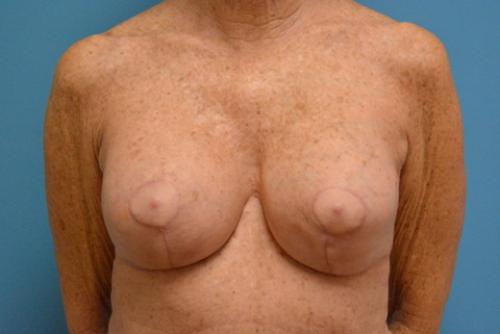 Breast Implant Revision/Replacement Before and After Pictures Fort Lauderdale, FL