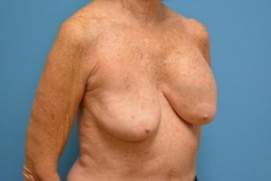 Breast Implant Revision/Replacement Before and After Pictures Fort Lauderdale, FL