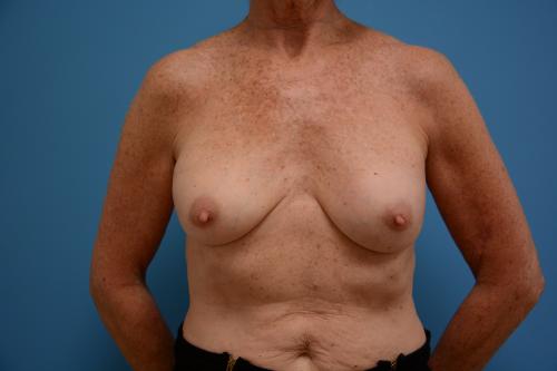 Breast Implant Revision/Replacement Before and After Pictures Fort Lauderdale, FL