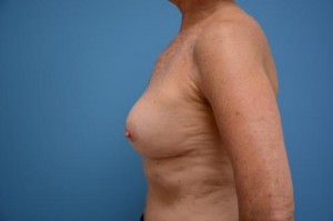 Breast Implant Revision/Replacement Before and After Pictures Fort Lauderdale, FL