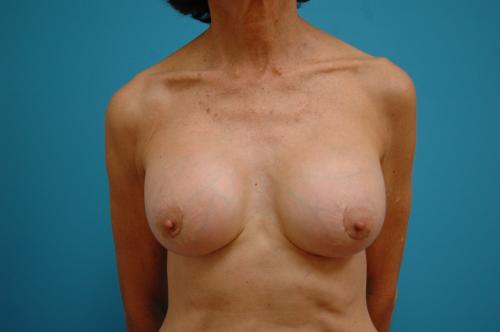 Breast Implant Revision/Replacement Before and After Pictures Fort Lauderdale, FL