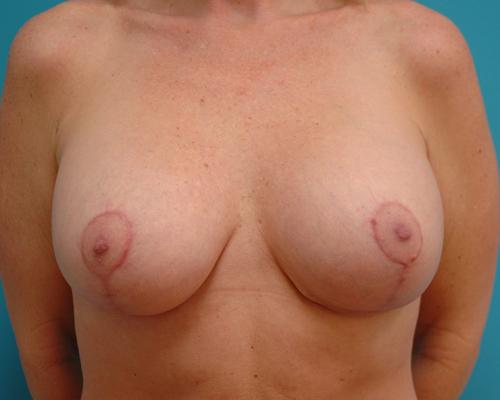 Breast Implant Revision/Replacement Before and After Pictures Fort Lauderdale, FL