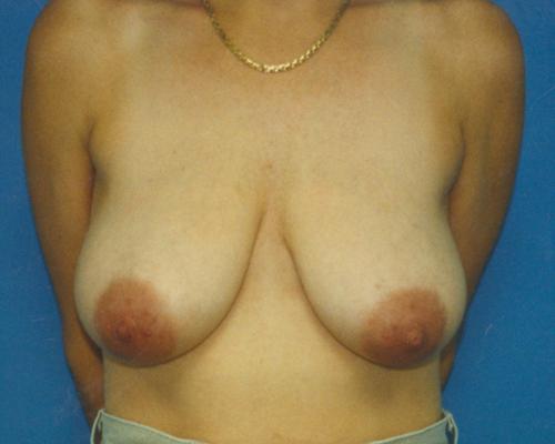 Breast Lift Before and After Pictures Fort Lauderdale, FL